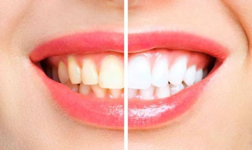 What Can I Eat After Teeth Whitening Treatment?