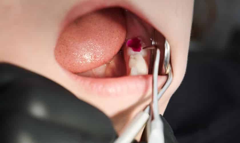 Dental Sealants Midwest City  - Midwest Smiles