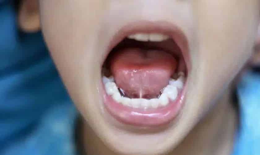 Frenectomy