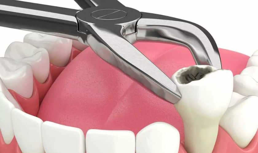 Tooth Extraction: Tips and Advice 