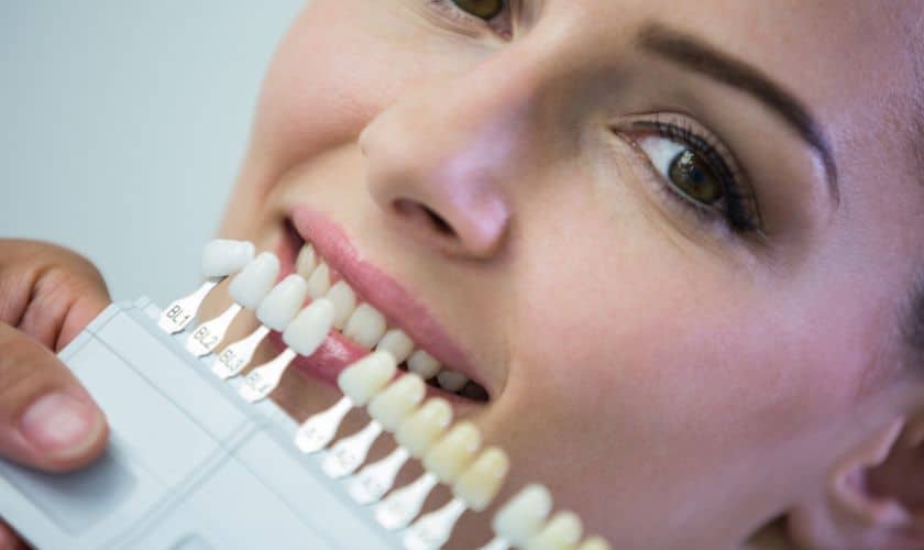 Porcelain Veneers