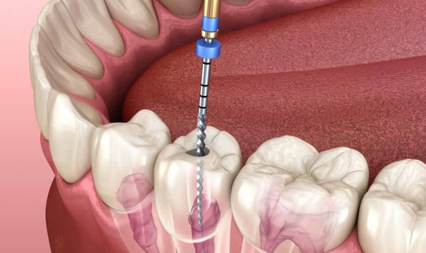 Experience Advanced Root Canal Therapy