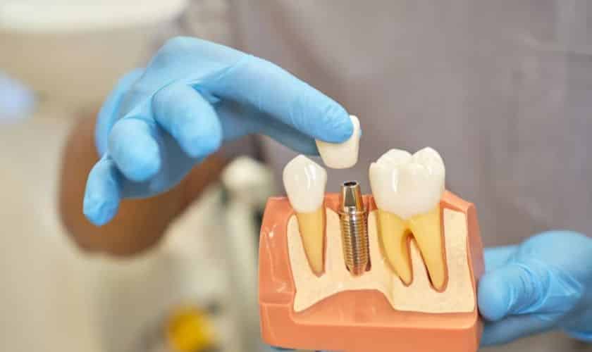 Dental Implants Midwest City - Midwest Smiles - Dentist Midwest City