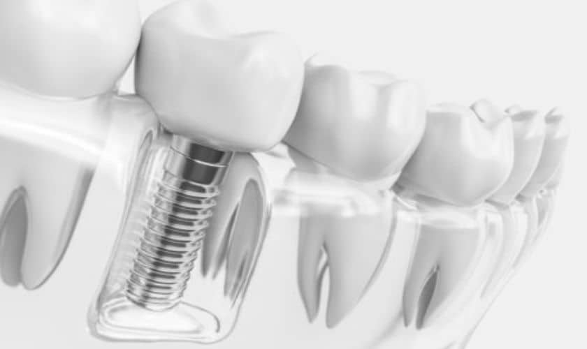 Dental Implants in Midwest City OK