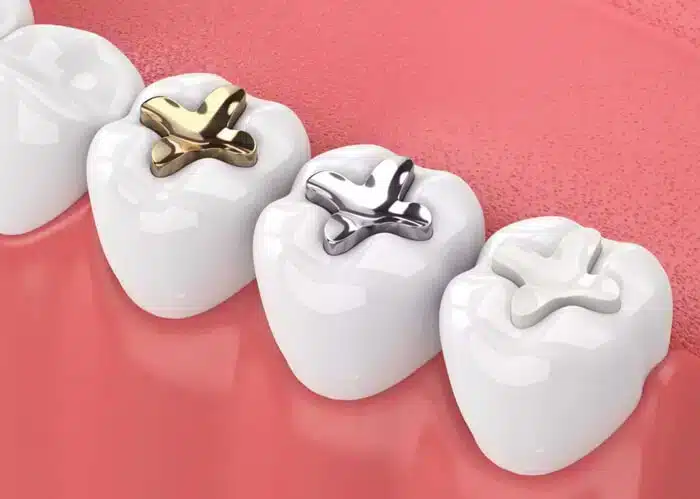 Composite Fillings
