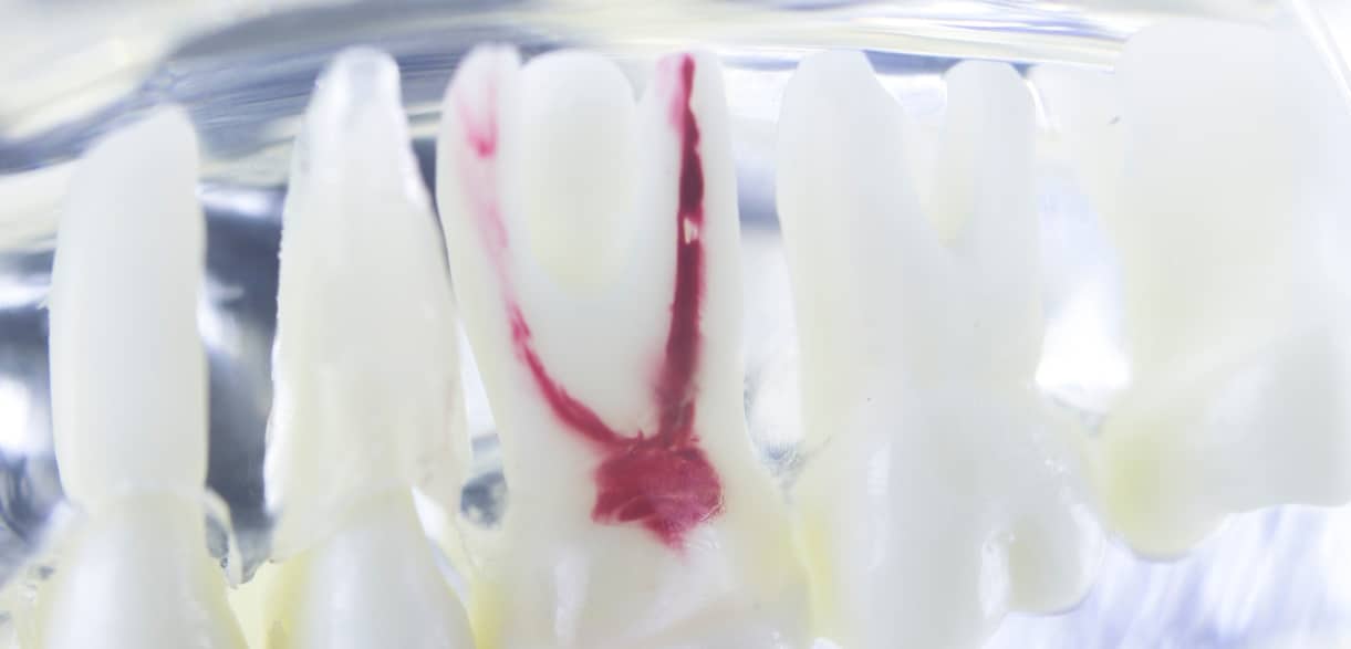 What To Do When A Root Canal Becomes Infected