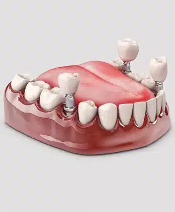 Dental Implants Midwest City - MIdwest Smiles