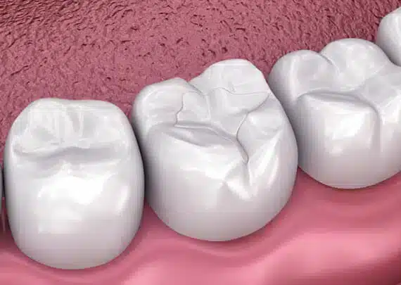 Dental Sealants Midwest City - Midwest Smiles