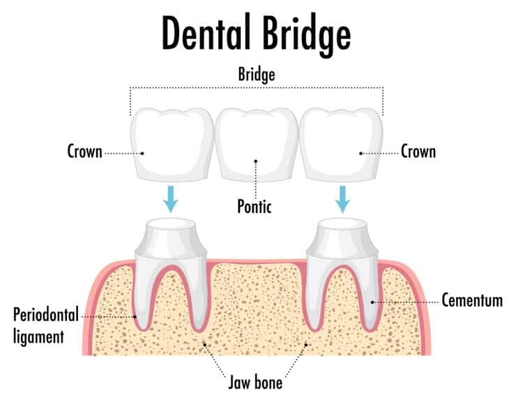 dental Bridge Midewest City 