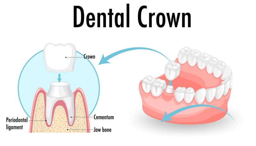 Dental crown Midwest City 