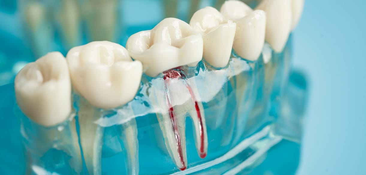 What is the Process for Emergency Root Canal Treatment